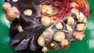 Hydatid cyst liver cyst due to Echinococcus infection [upl. by Roi]