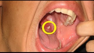 Tonsil Stones  Tonsillolith [upl. by Nnep]