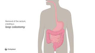 Creation of a loop colostomy by removing the rectum  Ostomy surgery  Coloplast India [upl. by Even621]