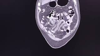 Mesenteric haematoma spontaneous  CT findings [upl. by Loar354]