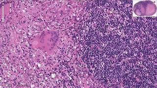 Tuberculosis of the Lymph Node  Histopathology [upl. by Rowland]