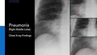 Pneumonia Right Middle Lobe Explanation of Chest Xray Findings [upl. by Ecinereb333]