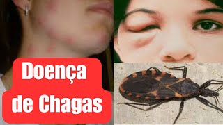 Doença de Chagas o que você precisa saber [upl. by Ynnahc726]