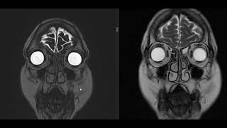 49 year female with left orbital pain [upl. by Gavrah914]