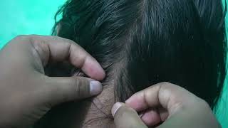 Lice Infested Catching and Popping Sounds  ASMR Lice Picking In My Head [upl. by Surovy]