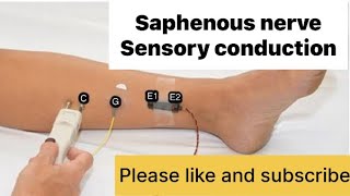 SAPHENOUS NERVE sensory nerve NCS neurology neurotech [upl. by Ahsirkal]