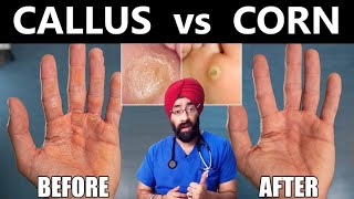 Corns vs calluses  Reason to Cure  Bodybuilders  Workers Hands  DrEducation [upl. by Abisia]