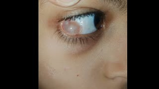 Hidden Swelling in eyes 👀  condition explained indetail eyecareoptom5506 eye eyelid swelling [upl. by Rudelson209]