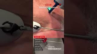 VBeam PulsedDye Laser Treatment [upl. by Saenihp852]