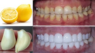 Teeth Whitening in 5 Minutes at Home 100Works [upl. by Acissey124]