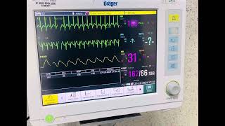 Taquicardia Supraventricular Paroxistica TSVP [upl. by Marchal]