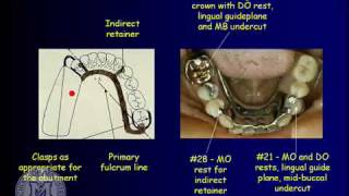 Removable partial denture maxillary definitive impression technique [upl. by Belvia]