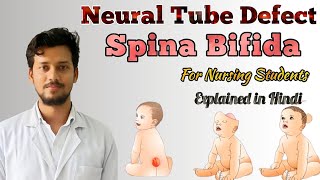 Neural tube defect nursing  spina bifida [upl. by Bolte]