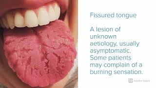 Oral Pathology  5 Tongue Leisons You Must know [upl. by Nazar]