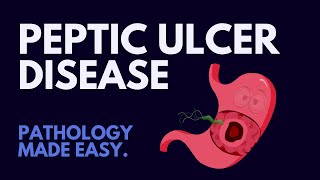 Peptic Ulcer Disease l Pathology Made Easy [upl. by Lebazej]