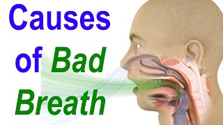 Sources of Bad Breath or Halitosis Evaluate Diagnose and Treat [upl. by Benkley]