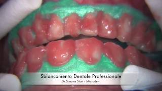 Sbiancamento Professionale dei Denti Teeth Whitening [upl. by Wellesley]