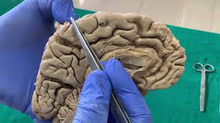 Dissection Sulci amp Gyri on Medial surface of brain [upl. by Immaj]