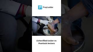 Psoriasis lesions vs Lichenified Lesions [upl. by Ybocaj]