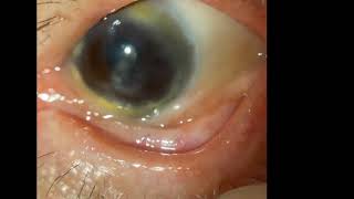 Ocular Cicatricial Pemphigoid [upl. by Lupe]