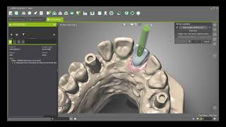 DWOS  Create an ASC Angulated Screw Channel [upl. by Enialedam]