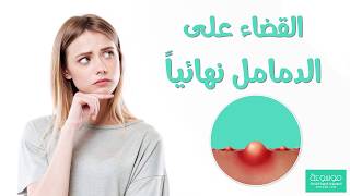 كيفية علاج الدمامل نهائيا ؟ أفضل خلطات علاج الدمامل [upl. by Esirehs547]