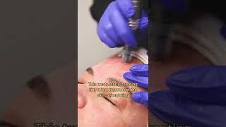 Hows a Micro Needling Skin Treatment microneedling [upl. by Victorine]