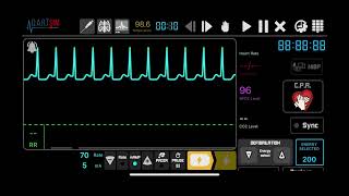 Supraventricular Tachycardia SVT Synchronised Cardioversion [upl. by Hancock]