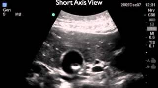 How To Gallbladder Ultrasound Part 2  Gallstones Case Study Video [upl. by Cornia]