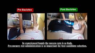 Intrathecal Baclofen Pump Surgery is so effective on Spasticity treatment [upl. by Ettenawtna]