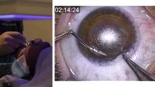 London Vision Clinic  ReLEx SMILE  Live laser eye surgery  Professor Dan Reinstein [upl. by Althee]