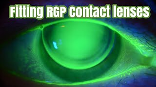 Fitting RGP Contact lenses [upl. by Cherish]