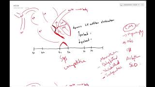 Hypertrophic obstructive cardiomyopathy HOCM  Dr Jamal USMLE [upl. by Nihhi]