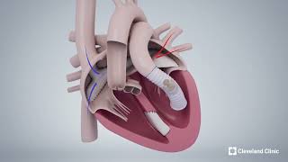 Ventricular Switch Heart Procedure [upl. by Anyalram]