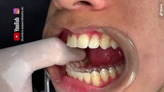 ¡🔥Instalación de retenedores dentales removibles🔥 [upl. by Devonna]