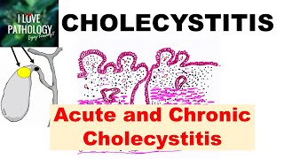 CHOLECYSTITIS Acute and Chronic Pathology and Complications [upl. by Eniaj]