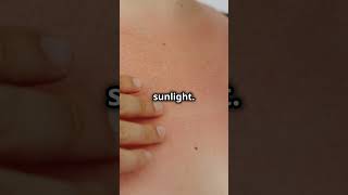 Porphyria Cutanea Tarda Skin Sensitivity to Sunlight health skincare raredisease DiagnosticLens [upl. by Giffie941]