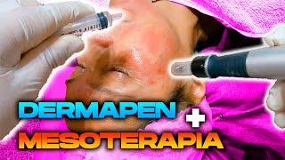 DERMAPEN  CURSO ONLINE 🏅 Fármacos de mesoterapia 🔥 2 Parte  Tutorial Microagujas [upl. by Eidaj543]