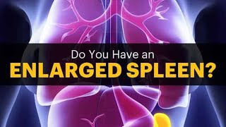 Splenomegaly Enlarged Spleen Splenitits Treatment and Cure [upl. by Eelta]