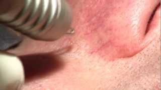 Dual Yellow laser  Facial telangiectasia 2  NORSELD  Thierry Rougeron  througeronyahoofr [upl. by Mccandless60]