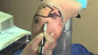 TAG Medical Arthroscopic Portal Placement for Arthroscopic Shoulder Surgery [upl. by Milli115]