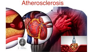 CVS Medicine 1 Atherosclerosis طب بغداد مرحلة رابعة [upl. by Eirahs39]