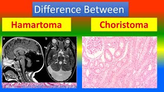 Difference between Hamartoma and choristoma [upl. by Yor]