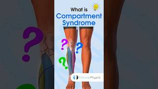 Compartment Syndrome anatomy physicaltherapy physiotherapy compartmentsyndrome [upl. by Aicel]