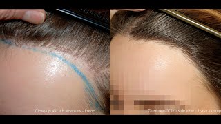 FUE Correction on 25YearOld Woman – Dr Feriduni Fixes Failed Hair Transplant [upl. by Broeder174]