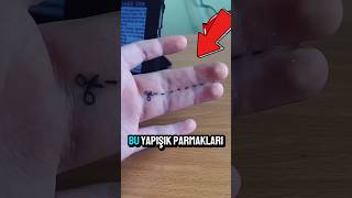 Yapışık Parmaklar Şaşırtıcı Bir Yöntemle Ayrılıyor Şok Olacaksınız 😱✂️😱makasyapışıkparmak [upl. by Grunenwald343]