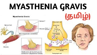 Myasthenia Gravis  Causes  Symptoms  Complications  Diagnosis  Treatment  தமிழ் [upl. by Lerret323]