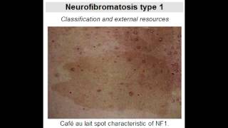 Neurofibromatosis Type 1 von Recklinghausens Disease [upl. by Oidualc651]