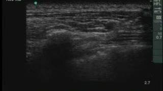 UltrasoundGuided Thoracic Paravertebral Block [upl. by Airotciv612]