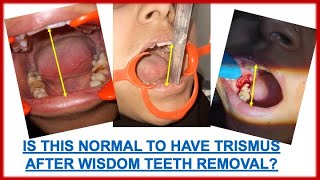 IS THIS NORMAL TO HAVE TRISMUS AFTER 3rd MOLAR EXTRACTION WISDOM TOOTH EXTRACTION ORAL SURGERY [upl. by Kee]